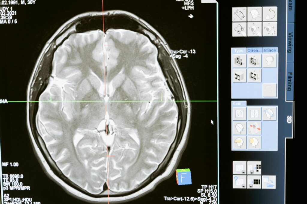 Brain MRI scan used for diagnosing acute neurological emergencies and critical brain conditions.